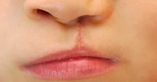 cleft palate